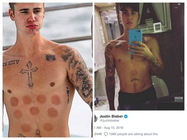 Justin Bieber Cupping