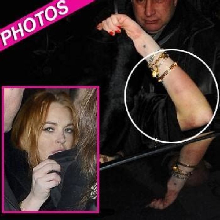 Lindsay Lohan Bruised